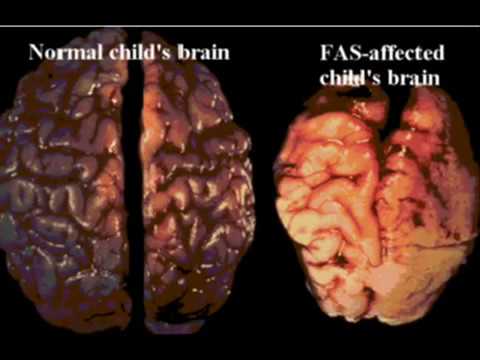 Screenshot of video: Effects of Fetal Alcohol Syndrome