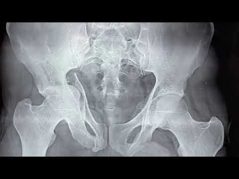 Pelvis fracture fixation