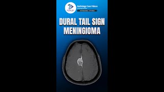 Dural Tail Sign in Meningioma | Radiology Teaching