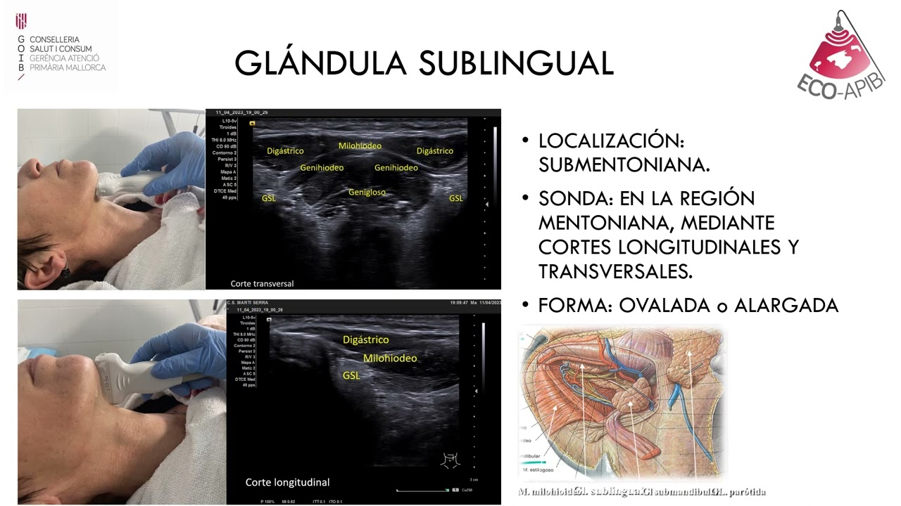 Ecografía Glándulas salivales Dra Mendieta  Parte III.