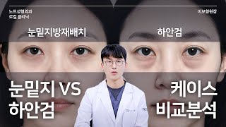 [이보형 원장의 Q&A] 제 눈은 무슨 케이스예요? l  눈밑지 l 하안검 l 신경 쓰이는 눈 밑 l 자가 진단법 l