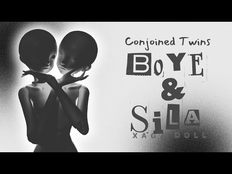 Conjoined Twins 💕 XAGA DOLL Boye and Sila