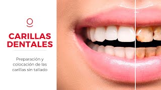 Carillas dentales sin tallar el diente. Preparación y colocación de carillas dentales en Alicante