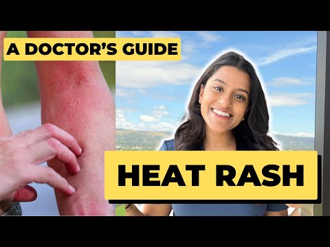 HEAT RASH TREATMENT? HOW to make HEAT RASH GO AWAY? 🧴 🔥 What is Heat Rash? How to treat Prickly Heat