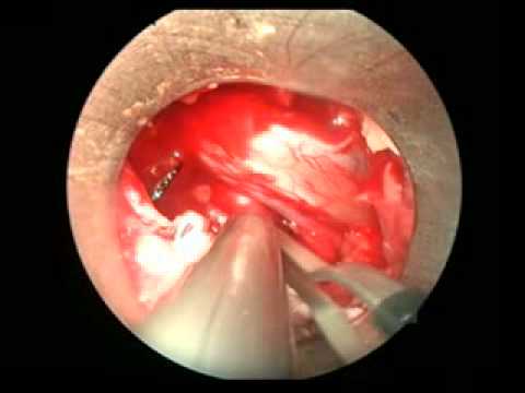 Endospine Tool Applied For The Endoscopic Disc Removal