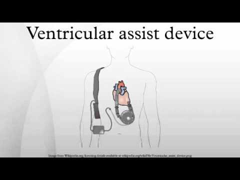 心室補助装置 (Ventricular assist device)