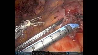 Core Videos (2024): Single Position Robotic-Assisted Laparoscopic Right Ileal Ureter Interposition
