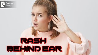 Rash Behind Ear: Know Why??? |  Symptoms & Treatment - Dr. Rasya Dixit | Doctors