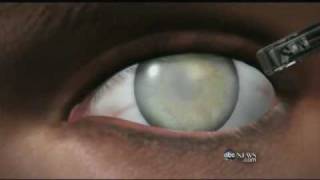 Medical Breakthrough: Restoring Sight to the Blind