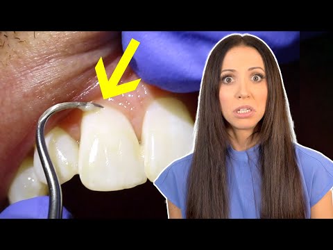 YouTube video about: Can teeth cleaning damage teeth?