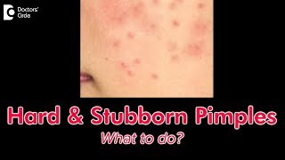 How to get rid of hard pimples? - Dr. Nischal K