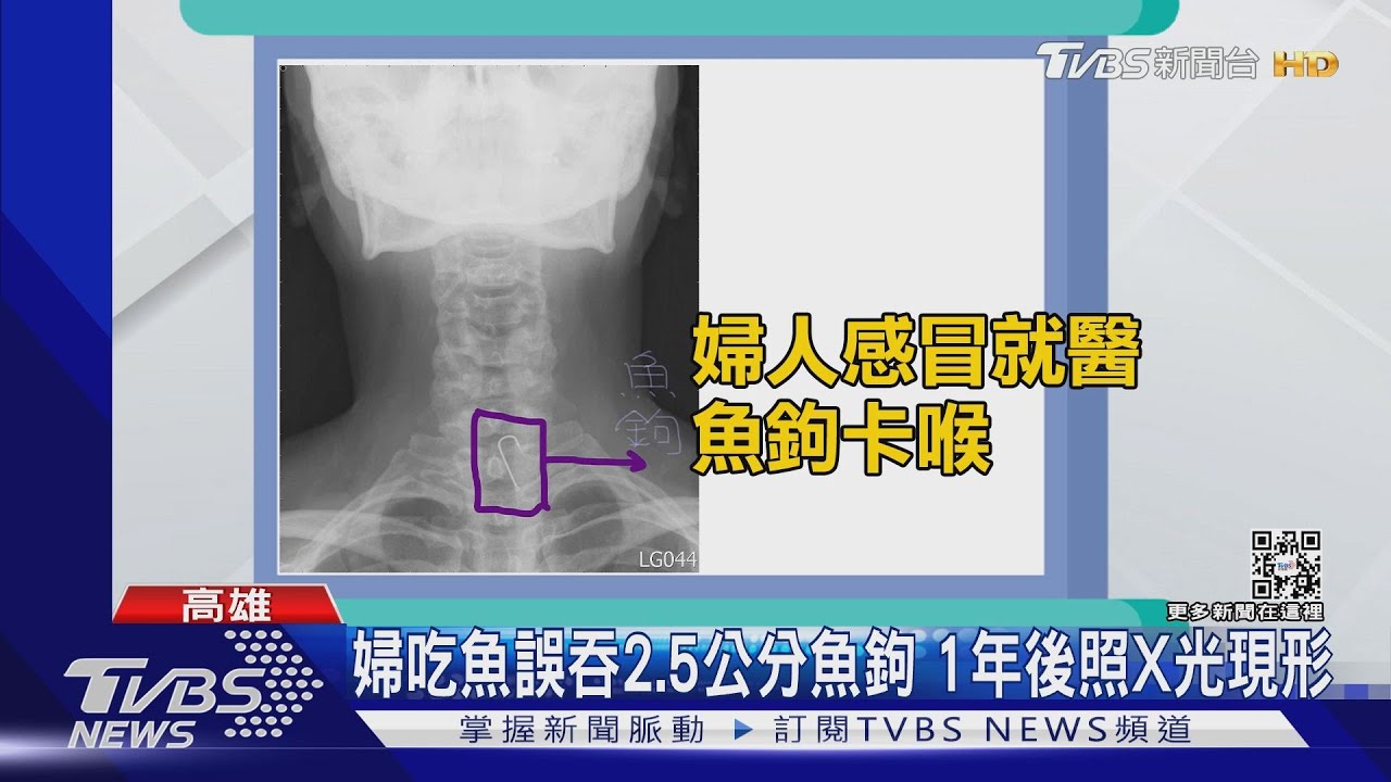 不可思議!婦吃魚誤吞2.5公分魚鉤 1年後感冒照X光現形
