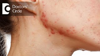 What causes acne scarring, keloids and recurring cysts on body? - Dr. Tina Ramachander