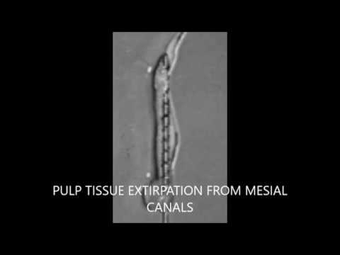 IMPORTANCE OF MASTER CONE RADIOGRAPH