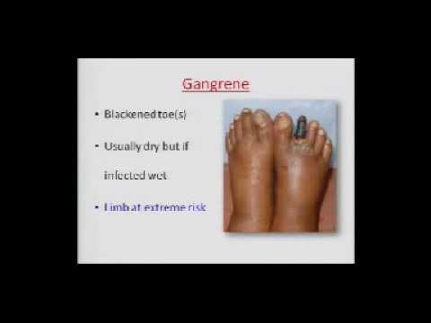 Current Status of Peripheral Vascular Disease