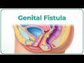 Genital Fistula Types Clinical Features Diagnosis Management