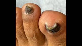 Ep_8696 Foot nails skin removal 👣 พี่ต้องงดทาเล็บก่อนสักพักนึง 😅 (clip from Thailand)