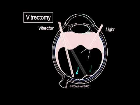 Vitrectomy 3/3