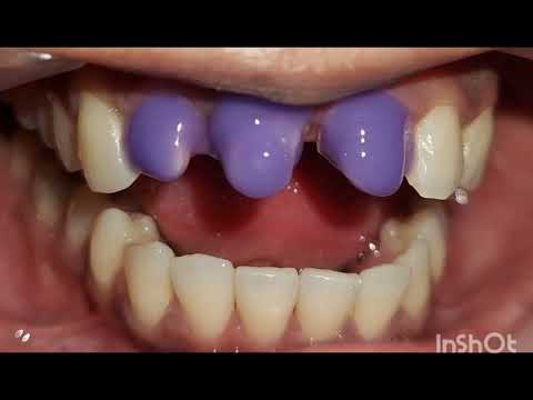 Ceramic Veneers | A case presentation | Dr. Reena Vora 