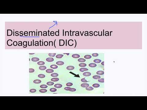Disseminated Intravascular Coagulation( DIC)