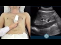 IVC Ultrasound | How to assess the IVC for volume status using ultrasound | Clarius Ultrasound
