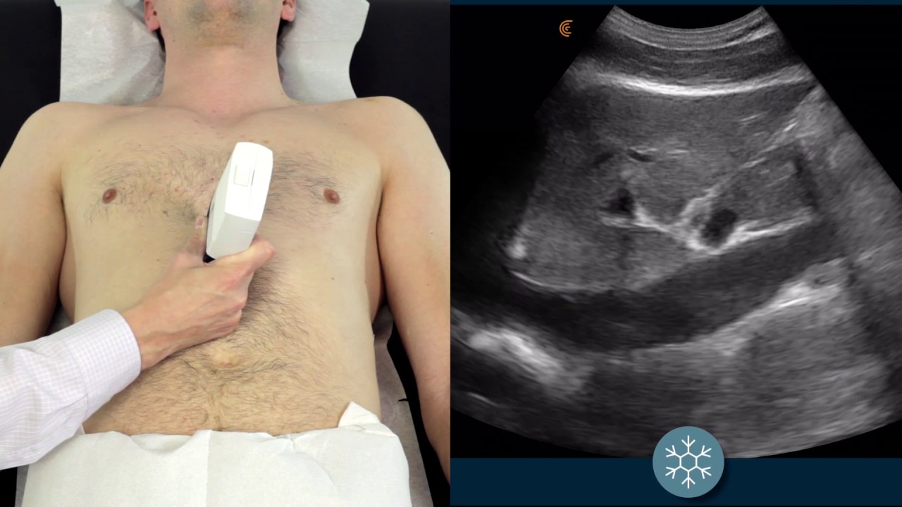 Watch Now IVC Ultrasound | How to assess the IVC for volume status using ultrasound | Clarius Ultrasound IVC Ultrasound | How to assess the IVC for volume status using ultrasound | Clarius Ultrasound