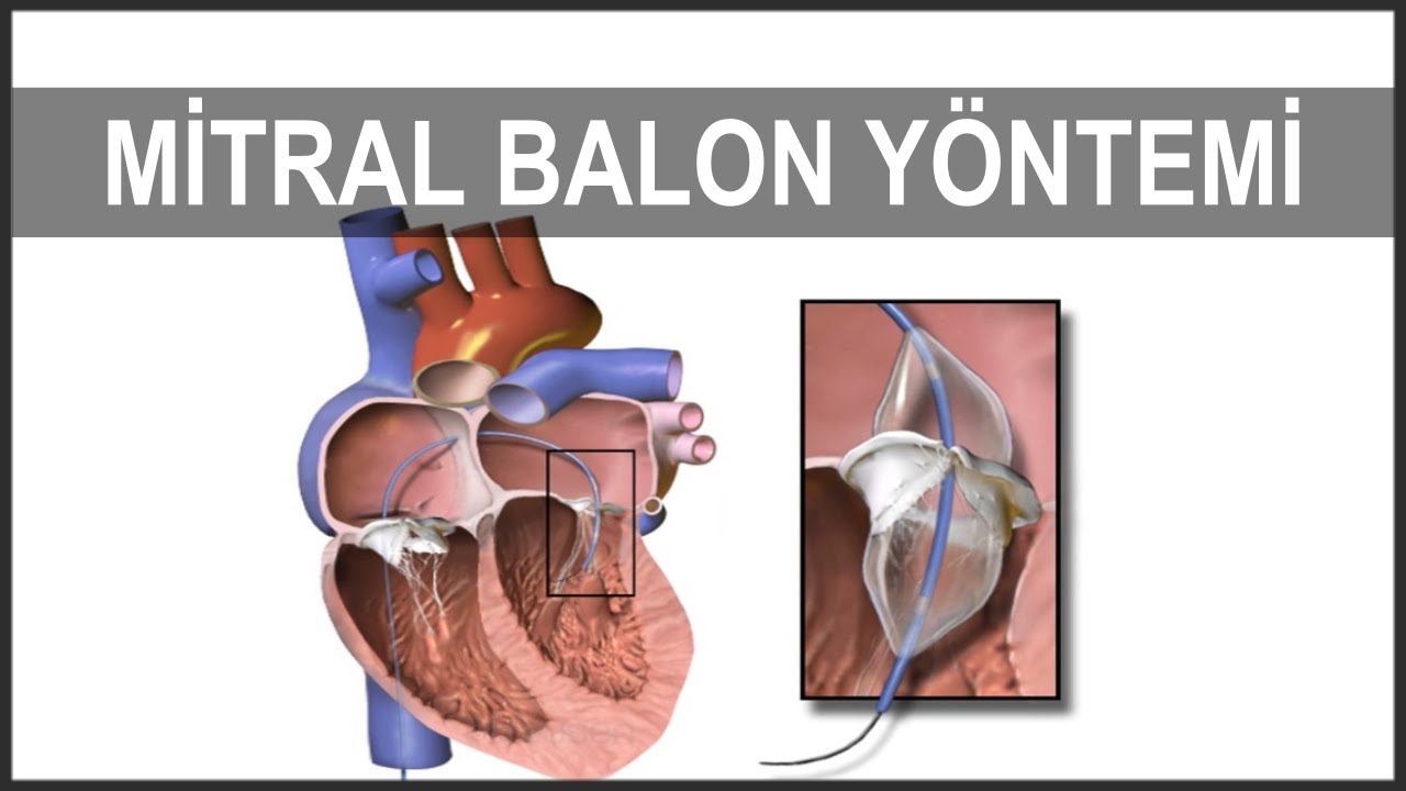 Mitral Balon