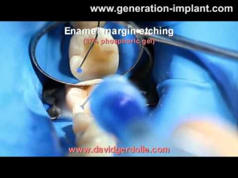 comment regler l'occlusion en prothese complete