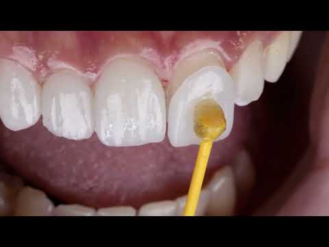 Waldent Veener stick