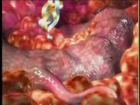 Enterobiosis pinworm