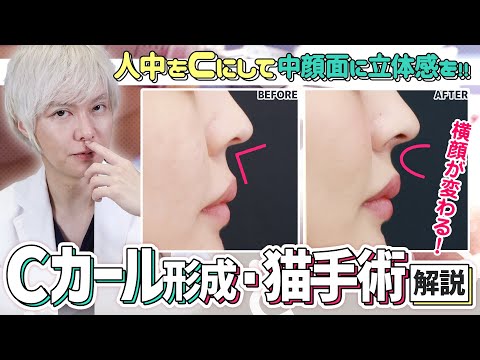【Cカール形成】人中短縮効果もあり！韓国で話題の鼻整形「猫手術」について解説しました。【大阪TAクリニック】