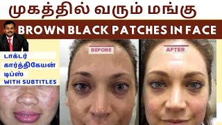 மங்கு மறைய டிப்ஸ்|Home remedies to remove brown black patches spots hyperpigmentation on face skin
