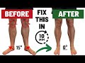 How To Fix Duck Feet FAST Fixing Ankle Dorsiflexion Tibial IR Hip IR