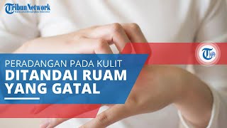 Dermatitis Numularis, Peradangan Kulit Berbentuk Koin atau Oval Ditandai Ruam Kulit yang Gatal
