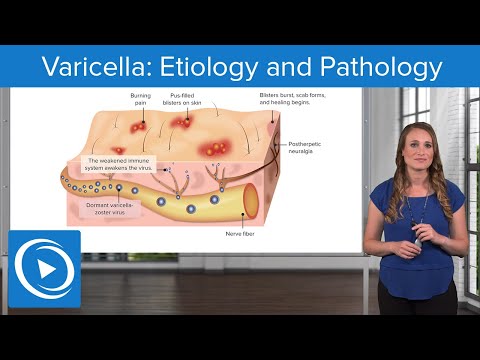 Varicella: Etiology and Pathology  – Pediatric Nursing | Lecturio Nursing