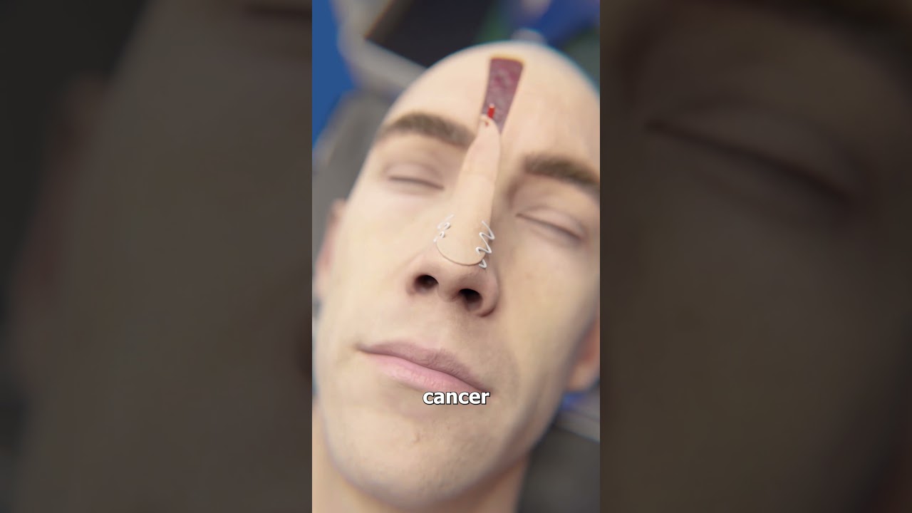 Forehead Flap Surgery 😨