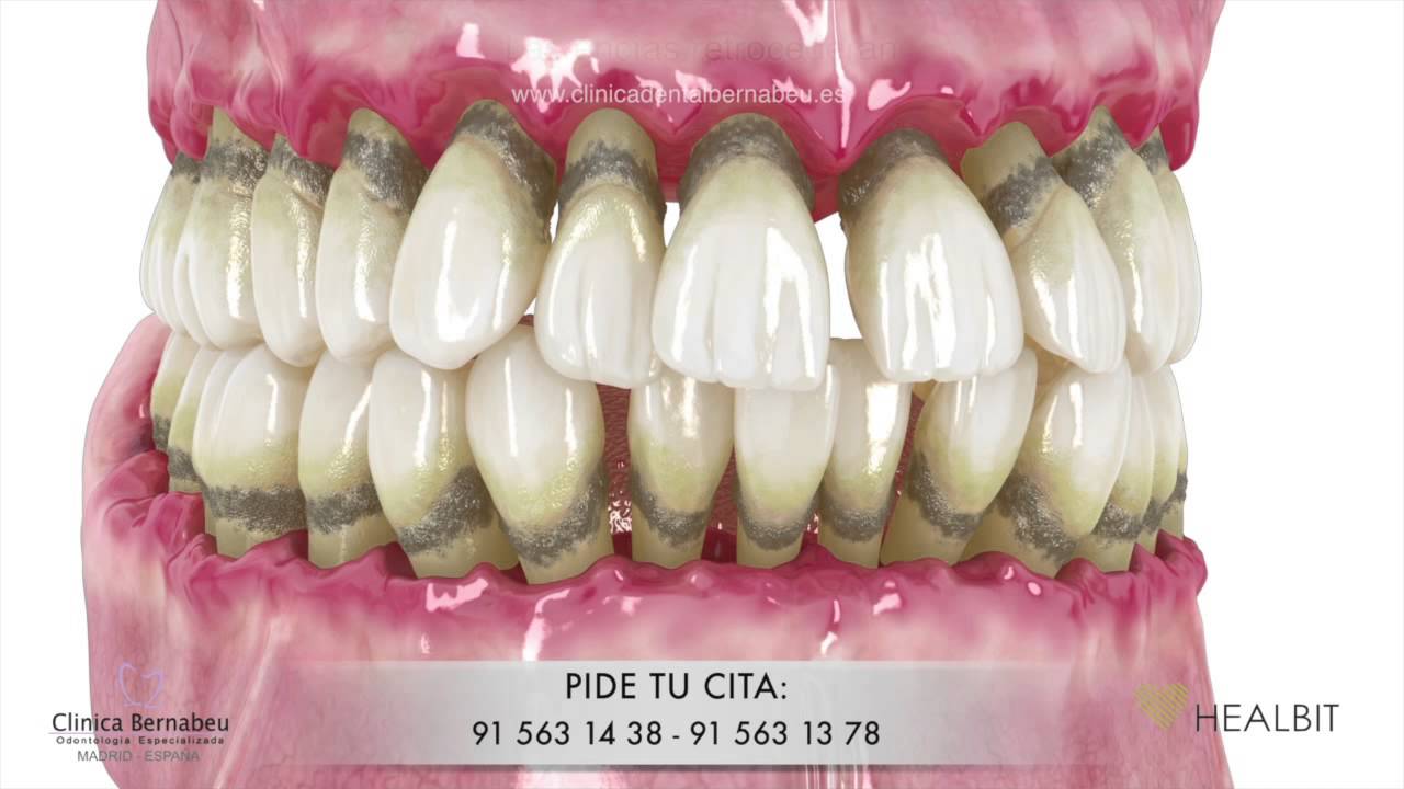 Periodoncia - gingivitis y periodontitis o piorrea