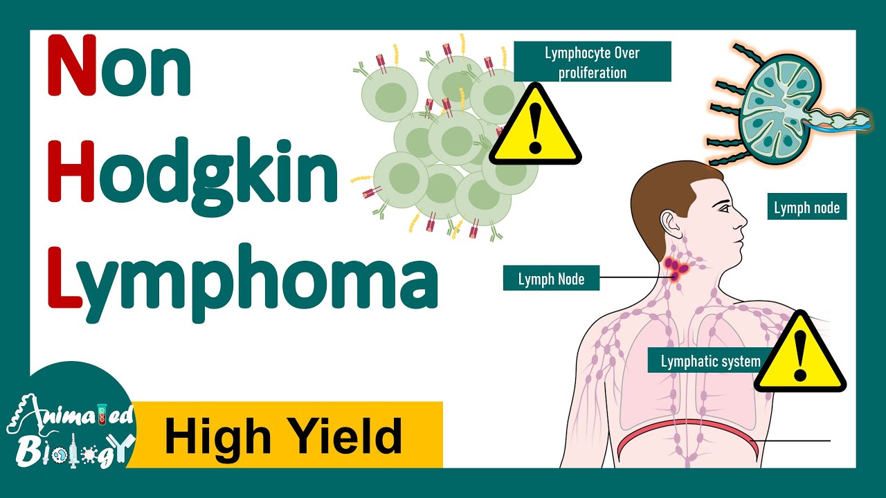 Non Hodgkin lymphoma  | Pathology and genetics of Non Hodgkin lymphoma | Diagnosis and treatment