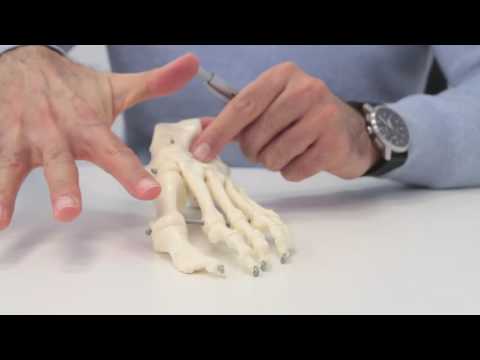 Hallux Valgus (bunion)