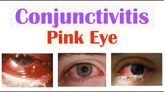 Acute Conjunctivitis (Pink Eye) | Allergic, Bacterial, Viral | Symptoms, Diagnosis, Treatment