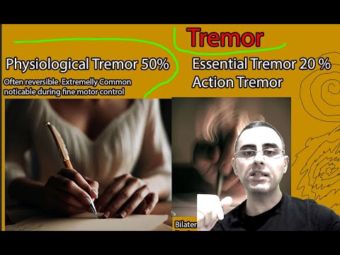 Tremor Causes:   Shaking hands (hand tremors): Physiological Tremor or Parkinson?