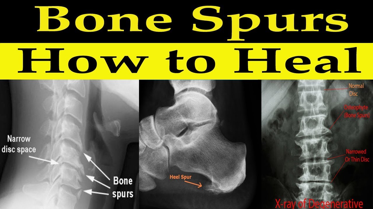 How to Heal Bone Spurs Naturally - Dr Alan Mandell, DC - YouTube