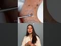 Mitesserentfernung Hautpflege Haut Skincare Skincaretips Hautarztperapp Pickel Pimplefree