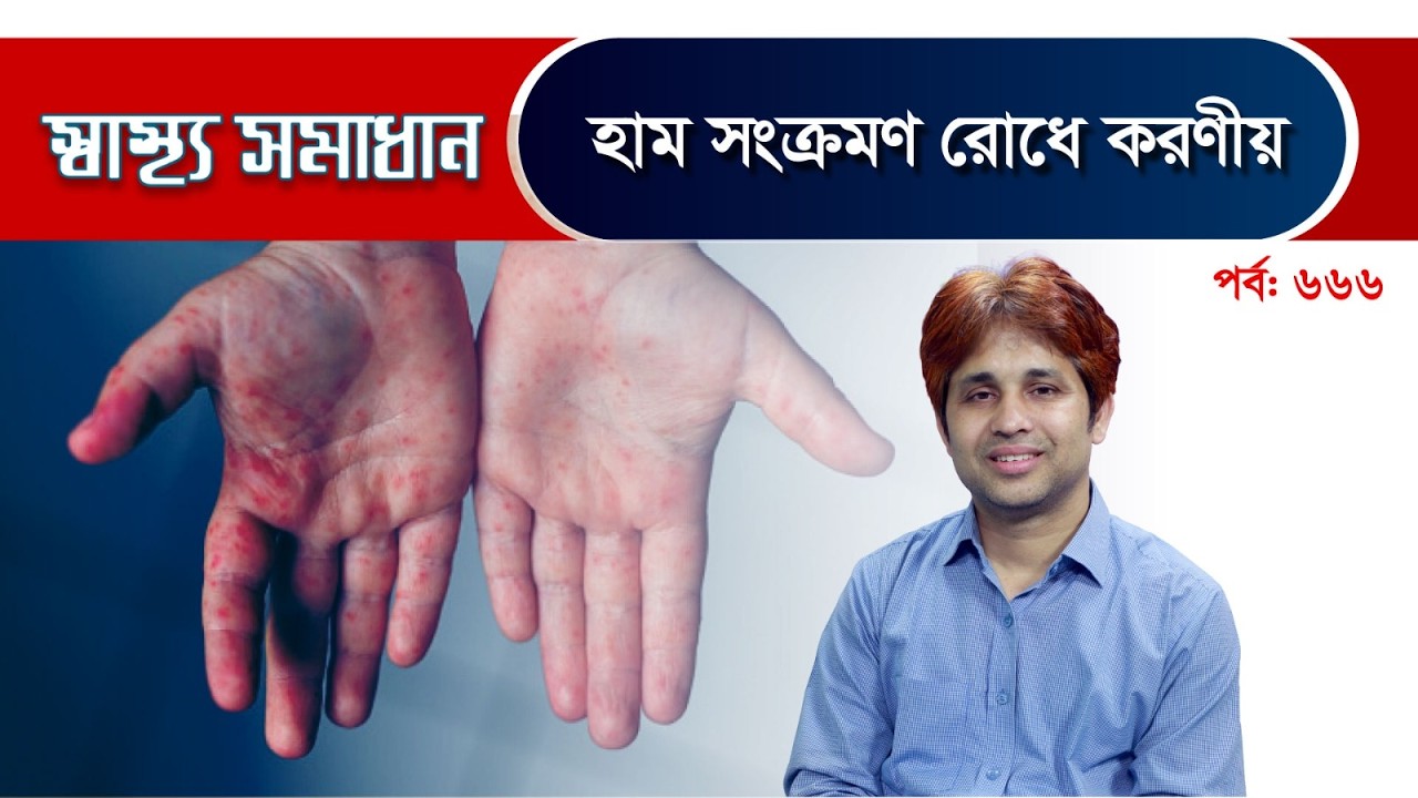 হাম সংক্রমণ রোধে করণীয়?