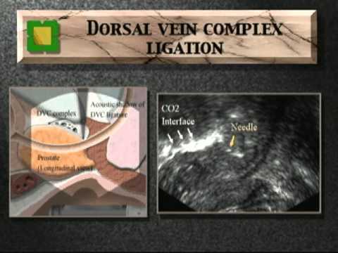 Prostata und Blähungen Wie mit Prostatakrebs essen