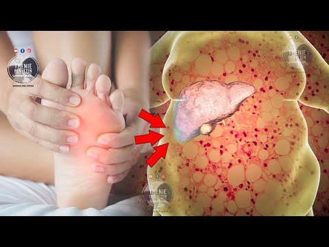 Mos i neglishoni këto shenja që jep mëlçia e sëmurë, do t'ju kushtojë shtrenjtë