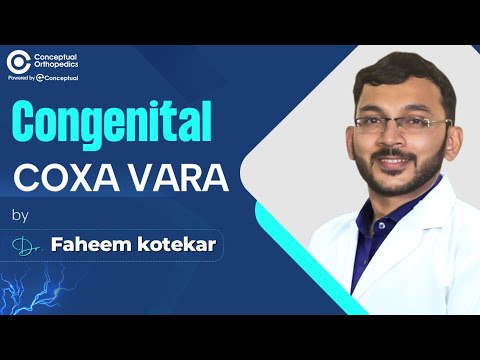 Understanding Congenital Coxa Vara: Diagnosis, Clinical Features, and Treatment Options | Dr Faheem