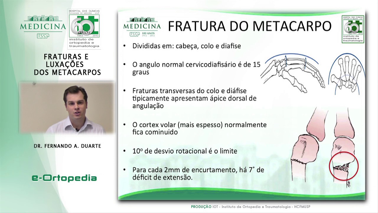 Fraturas e Luxaçoes dos Metacarpos - Dr. Fernando A. Duarte