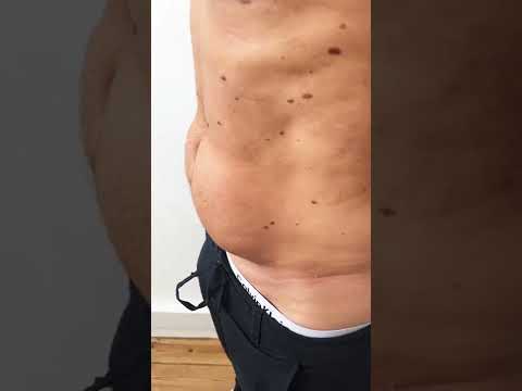 Do you have a stubborn lower abdomen? Subscribe now and learn more!