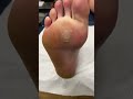 Remove Very Deep Forefoot Callus Using Scalpel Podiatry Treatment For Corns And Calluses